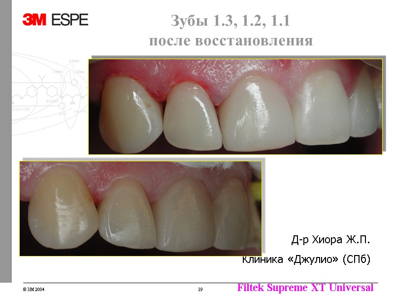 Зубы 1.3, 1.2, 1.1 после восстановления Д-р Хиора Ж.П. Клиника «Джулио» (СПб) Зубы 1.3, 1.2, 1.1 после восстановления Д-р Хиора Ж.П. Клиника «Джулио» (СПб)